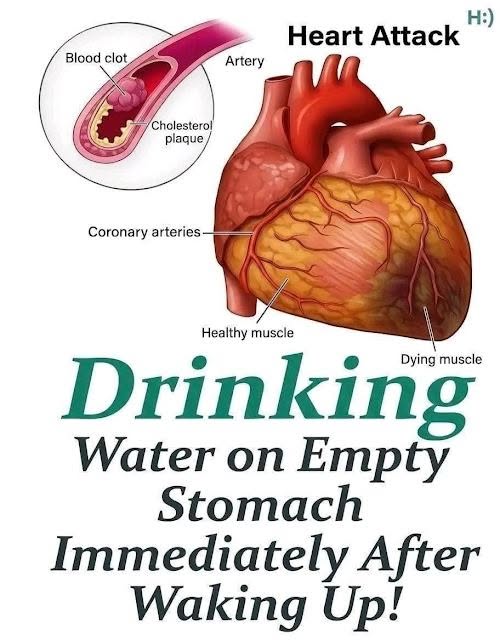 : Heart attack illustration with a headline claiming that drinking water immediately after waking affects heart attack risk.