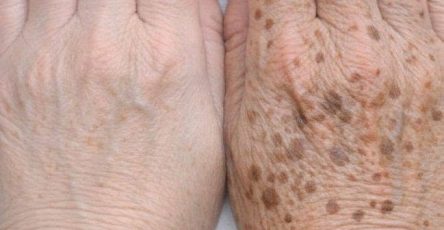 Comparison showing Age Spots on Hands and more evenly pigmented hand skin