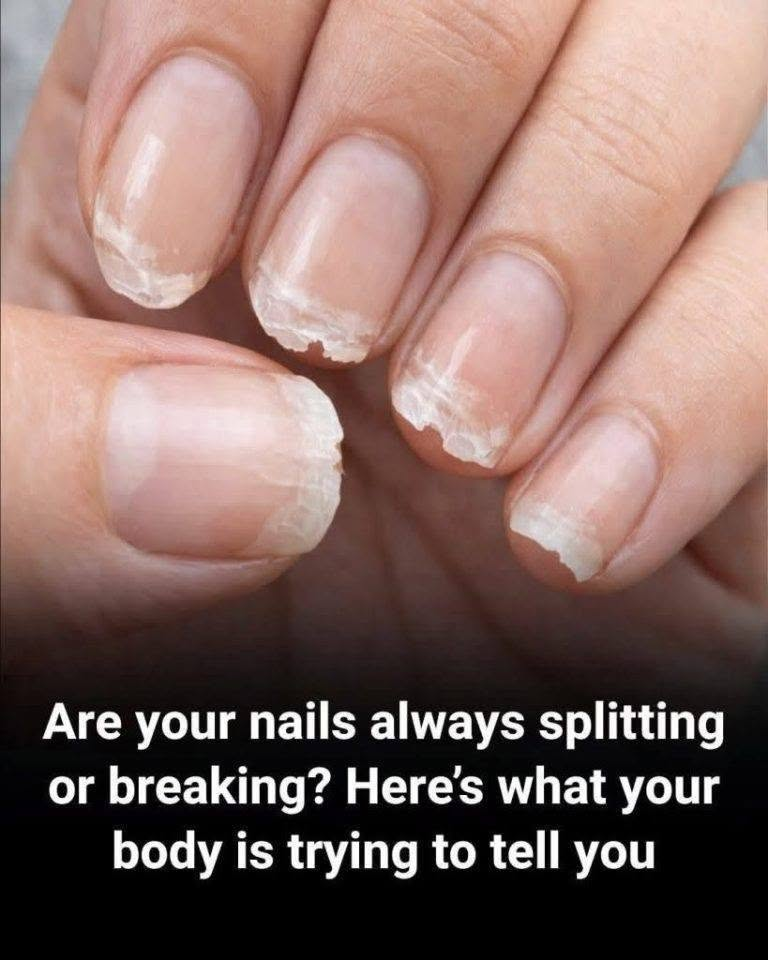 Close-up of splitting and breaking nails with peeling tips