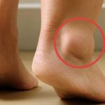Swollen feet and ankle showing signs of edema